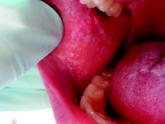 WCD: Red gums raise red flag in oral lichen planus